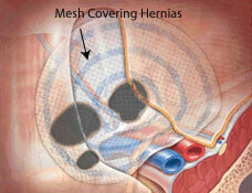 Inguinal-Hernia-Defects-Covered